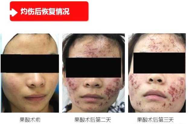 甘醇酸60可以刷脸吗？在家用甘醇酸刷酸教程