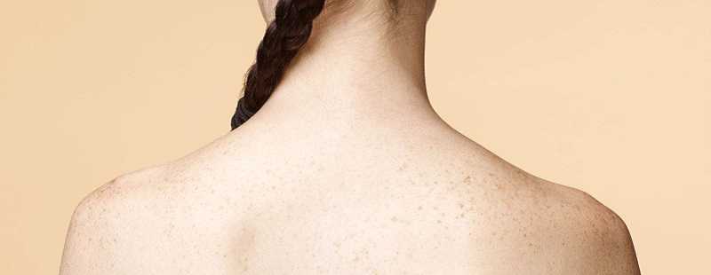 后背长痘痘是什么原因 后背长痘痘是什么原因