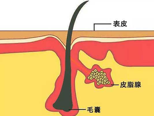 皮脂细丝与黑头的区别