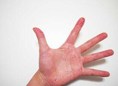 辣椒辣到手了怎么办?9种方法都可以快速去掉辣椒 辣椒辣到手了怎么办?9种方法都可以快速去掉辣椒