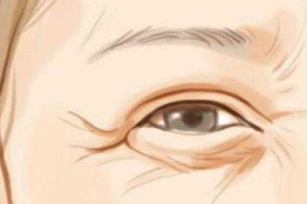 鱼尾纹除皱针打一次能保持多久 鱼尾纹除皱针有什么副作用