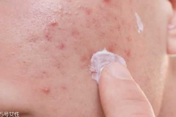 敷完面膜长痘痘是什么原因