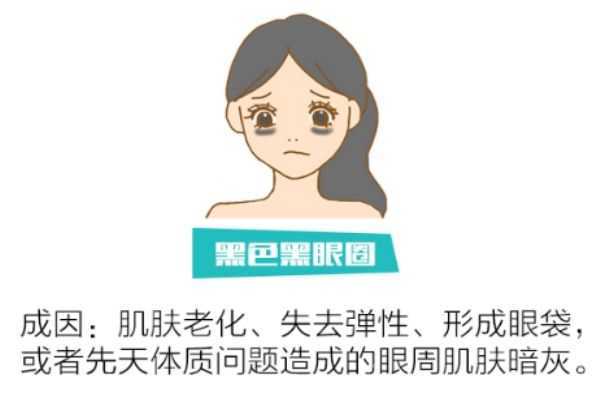 如何分辨黑眼圈类型