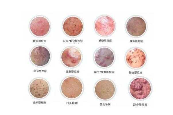 青春痘怎么快速消除？青春痘一般多久会消失