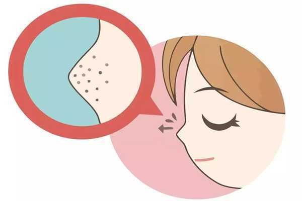 黑头是怎么产生的?黑头可以挤吗 黑头是怎么产生的?黑头可以挤吗