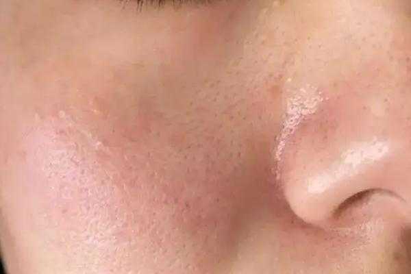 皮肤出油是因为皮肤缺水吗 皮肤出油是身体哪里出问题了