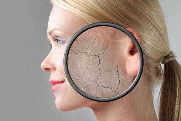 皮肤干燥怎么解决？皮肤干燥是缺什么维生素吗？