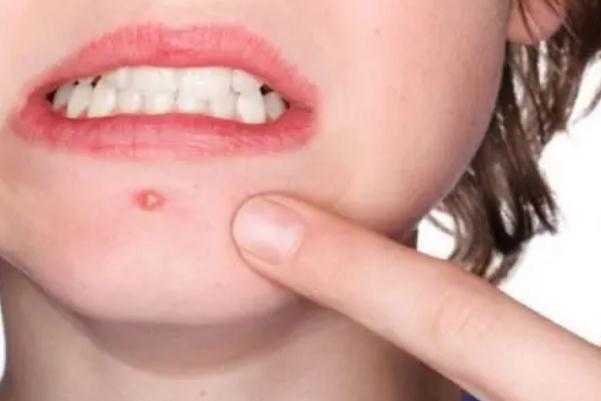 粉刺会留下痘印么?粉刺会长在哪些地方 粉刺会留下痘印么?粉刺会长在哪些地方