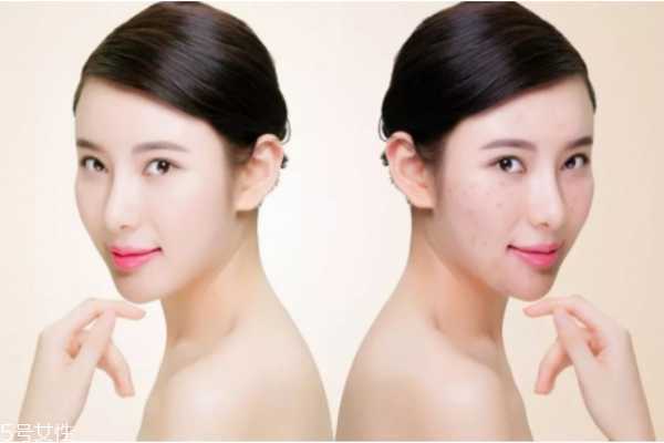 什么皮肤需要去角质 深层清洁不是所有人都适合