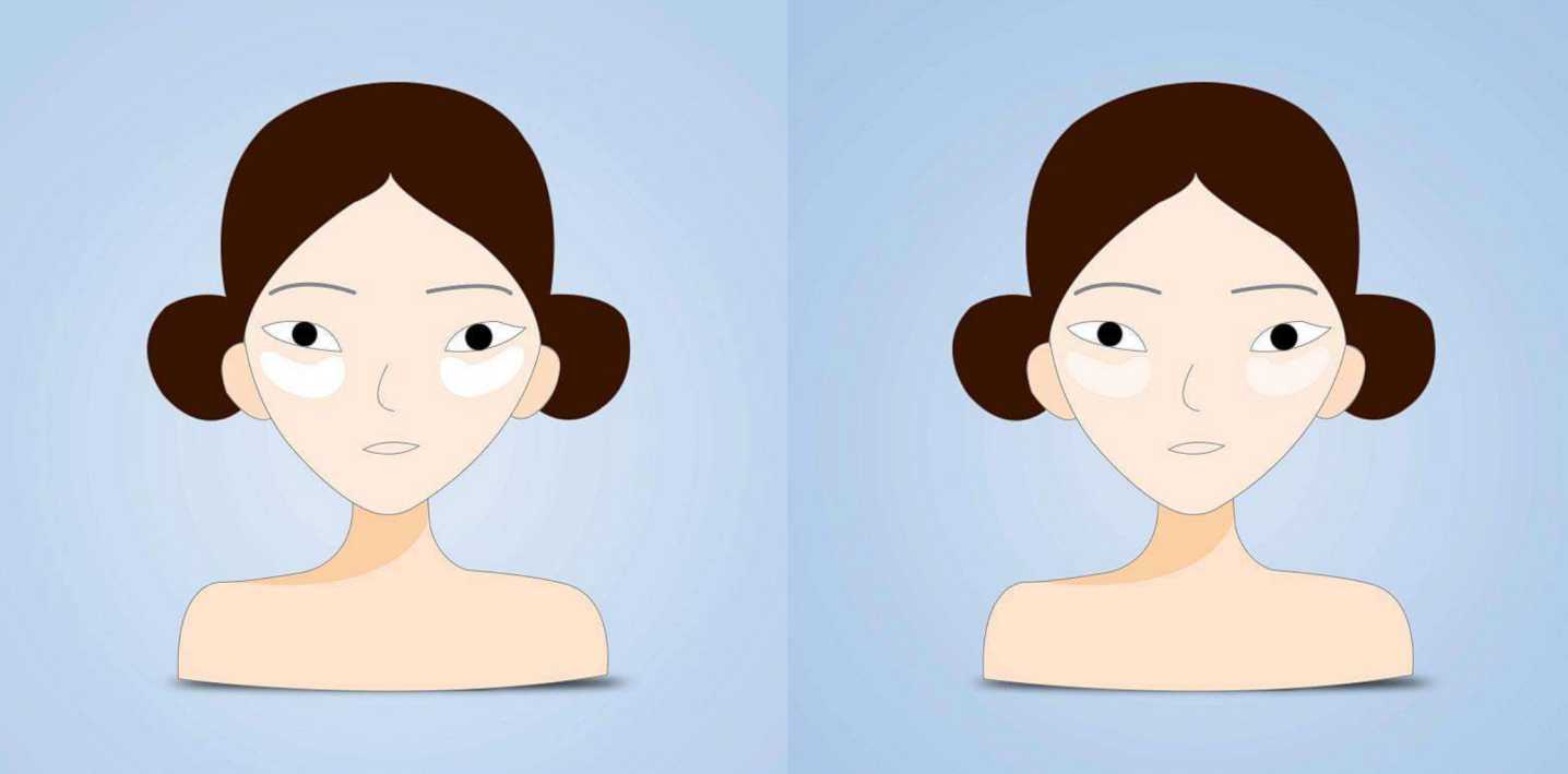 眼膜有正反面吗 眼膜有正反面吗