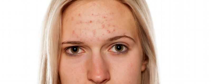 快速痘印祛除小方法 快速痘印祛除小方法