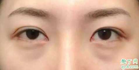 去眼袋手术是内路好还是外路好