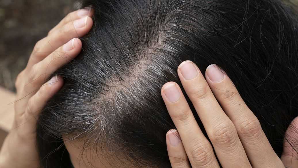 掉发严重怎么办 掉发严重怎么办