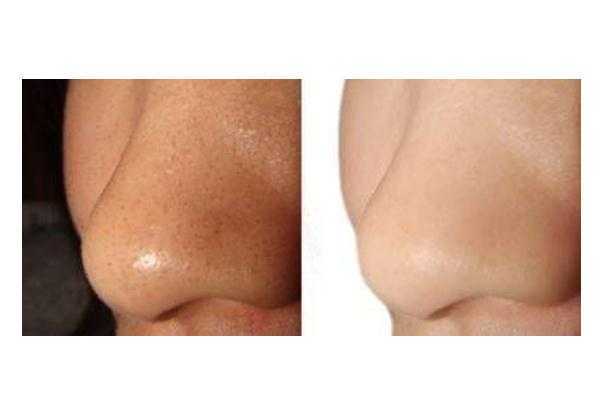 去黑头最有效的药膏 去黑头收缩毛孔的最好方法