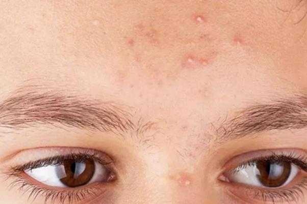 粉刺对身体有什么影响 挤黑头粉刺会对皮肤有哪些影响