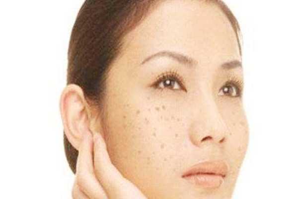 玫瑰花能去除黄褐斑吗 玫瑰花能去除黄褐斑吗