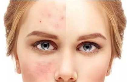 刷酸后用洗吗 刷酸后可以敷面膜吗