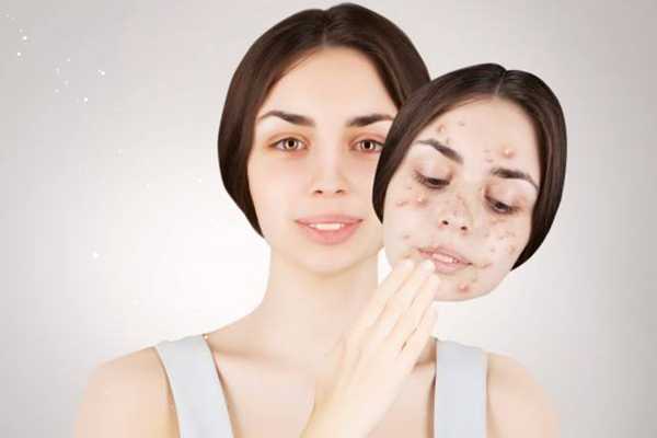 粉刺是怎么产生的?粉刺是什么样子 粉刺是怎么产生的?粉刺是什么样子