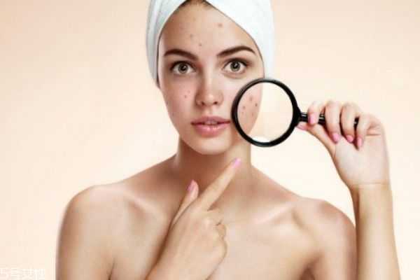 痘痘里为什么会有脓