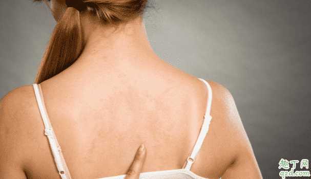 背后长痘是不是有螨虫?后背长痘痘怎么调理好 背后长痘是不是有螨虫?后背长痘痘怎么调理好