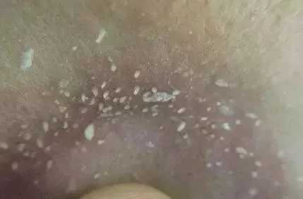 脸上毛孔里面有白色的渣渣是什么 脸上毛孔里面有白色的渣渣是什么