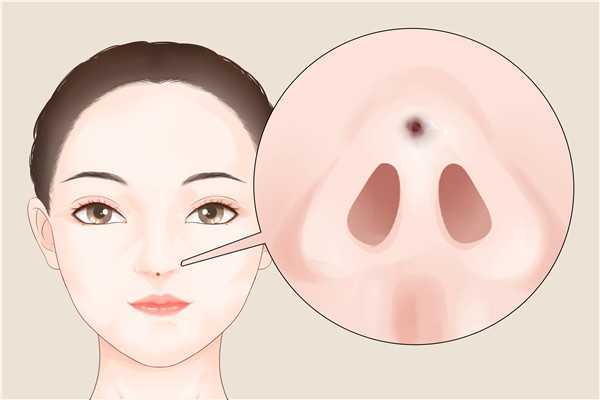 鼻子黑头是怎么回事 鼻子黑头是怎么回事