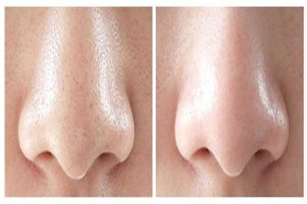 黑头可以自己消失吗 黑头可以自己消失吗