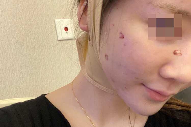 面部微雕一次一般多少钱？面部线雕一到7天图片