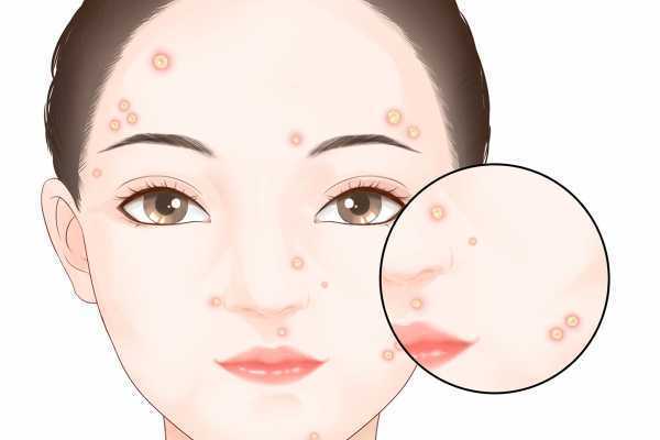 排毒养颜胶囊去痘吗 排毒养颜胶囊去痘吗