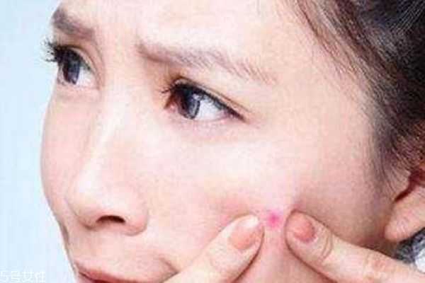 痤疮如何治疗效果好