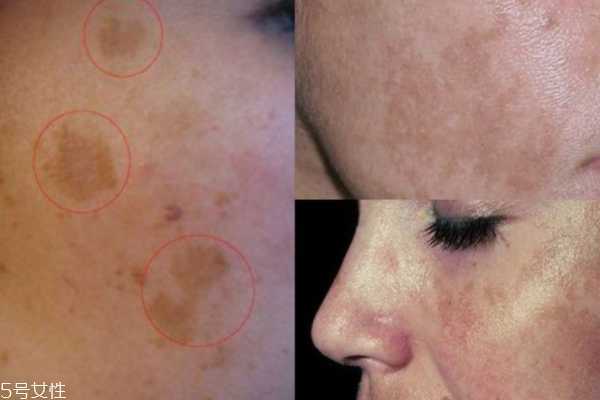 孕斑长什么样子