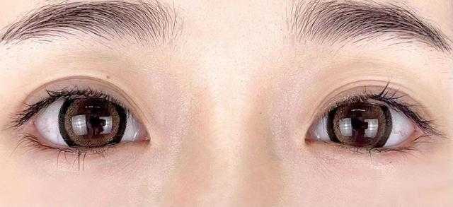 眼部皮肤干燥怎么办