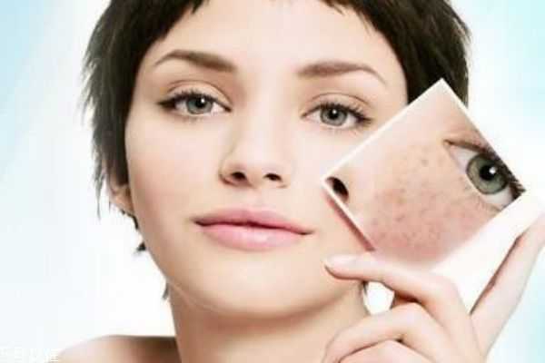 痤疮如何治疗效果好