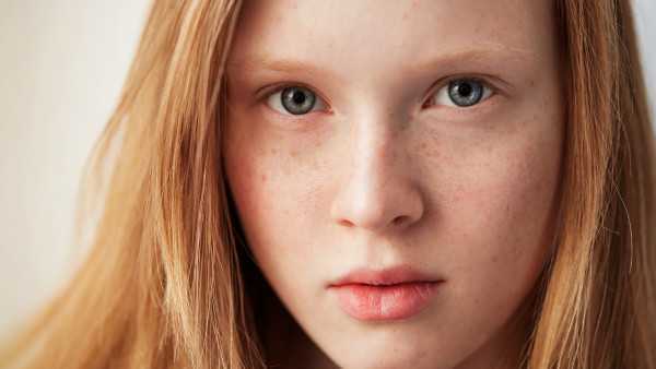 激光去雀斑后几天可以洗脸 激光去雀斑后几天可以洗脸