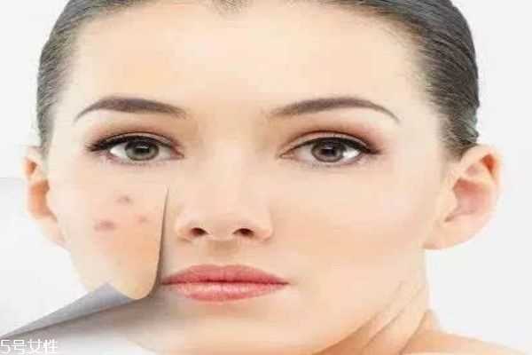 痘痘肌应该用什么面膜呢 痘痘肌应该用什么面膜呢