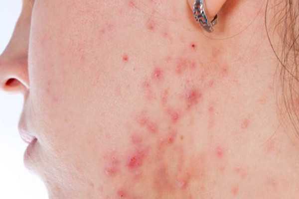 痘痘挤了之后能用酒精消毒吗 痘痘挤了之后能用芦荟胶吗