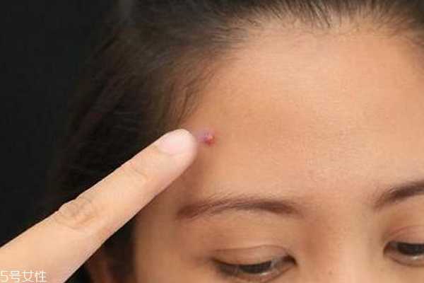 什么痘痘不能挤