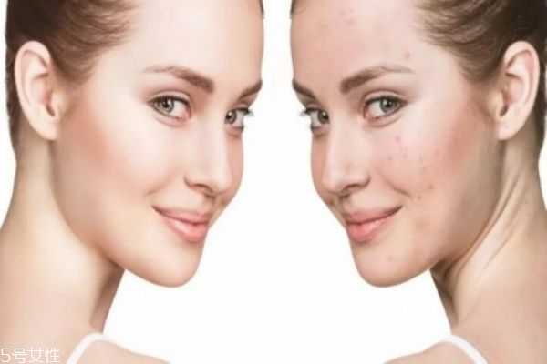 油皮痘痘肌用什么卸妆 这样才卸的干净