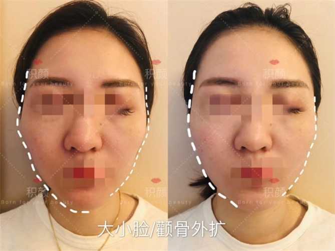 日式整骨可以改变大小脸吗 日式整骨可以改变大小脸吗