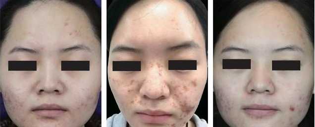 甘醇酸60可以刷脸吗？在家用甘醇酸刷酸教程