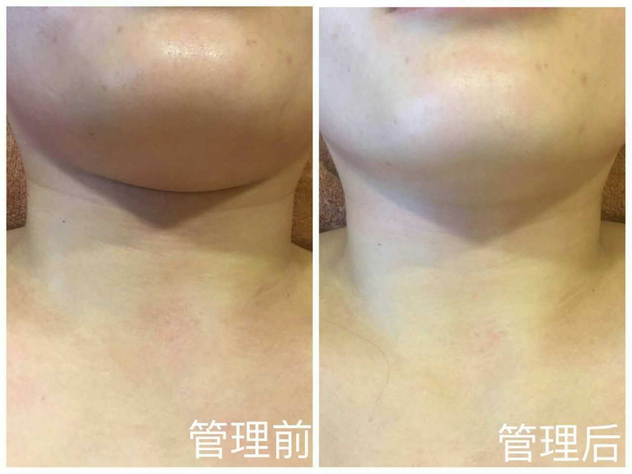徒手整骨整形前后对比照片