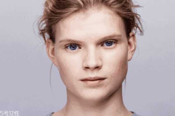 敏感肌换季过敏怎么办