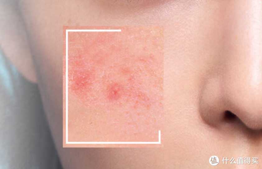 刷酸堪比换皮？什是刷酸？你适合吗？关于刷酸的科普篇！