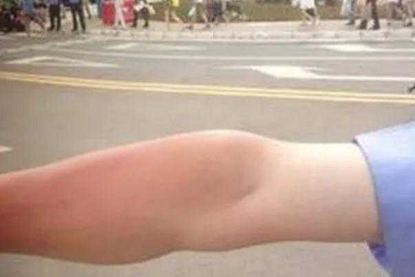 皮肤晒伤发红怎么修复 皮肤晒伤怎么处理最好