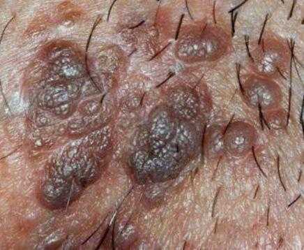 感染hpv的痘痘长啥样(附图) 感染hpv的痘痘长啥样(附图)