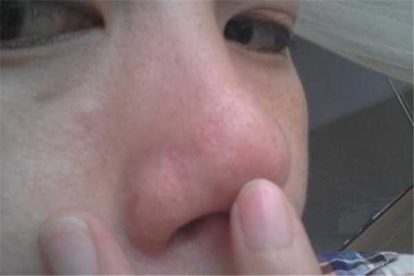 皮肤出油毛孔粗大怎么办 皮肤出油毛孔粗大怎么办