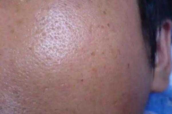 毛孔粗大有色斑怎么改善 毛孔粗大有什么危害