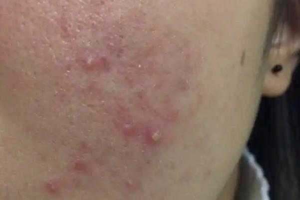 毛孔粗大会自己好吗