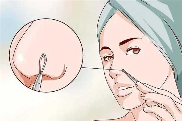 黑头毛孔粗大怎么办？黑头会导致毛孔粗大吗