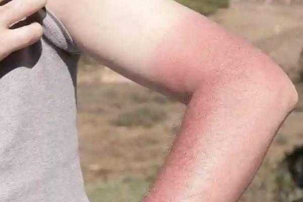 皮肤晒伤有什么办法?自己会恢复吗 皮肤晒伤有什么办法?自己会恢复吗